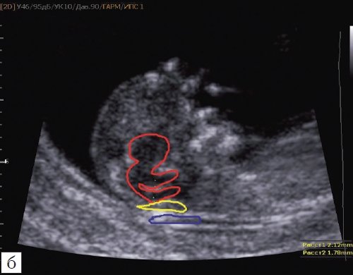 Эхограмма - измерение и взаимоотношение ножек осьминожки - ствола мозга и IV желудочка у плода: красный цвет - диэнцефалон (таламус), со стволом мозга (верхняя ножка) и IV желудочком (нижняя ножка); желтый цвет - большая цистерна головного мозга; синий цвет - воротниковое пространство