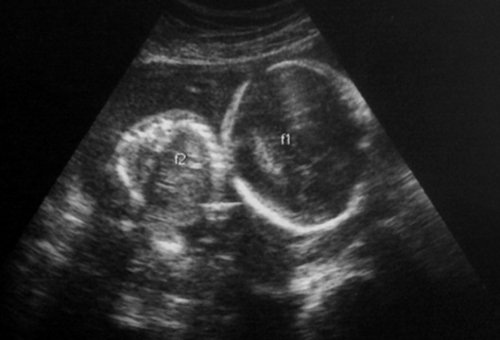 Эхограмма - двуплодная монохориальная беременность 25 недель: поперечное сечение туловища плода-донора (слева), аксиальное сечение головы плода-реципиента (справа)