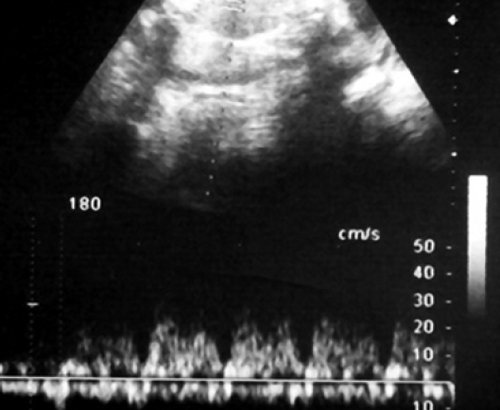 Эхограмма - начальная стадия нарушения венозной гемодинамики плода-реципиента, повышение резистентности в венозном протоке