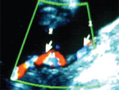 Эхограмма (режим ЦДК) - внеплацентарные пуповинные аномалии: гипоплазия и оболочечное прикрепление пуповины плода-донора (правее), краевое отхождение от плаценты пуповины плода-реципиента (слева), визуализируется участок пуповины меньшего диаметра, в котором отсутствует регистрация кровотока (стрелка) - нефункционирующий внеплацентарный шунт