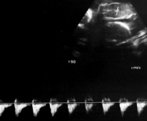 Эхограмма - длительно регистрируемый нулевой диастолический кровоток в аорте близнеца-донора, отсутствует визуализация мочевого пузыря плода