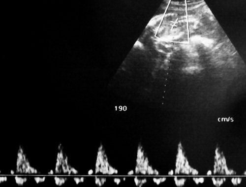Эхограмма - реверсный диастолический кровоток в торакальной аорте близнеца-донора, в условиях фето-фетальной трансфузии спектры, характерные для терминальной фетальной гемодинамики