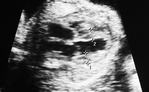 Эхограмма - гипертрофическая компенсаторная кардиомегалия плода-реципиента (беременность 26-27 недель)