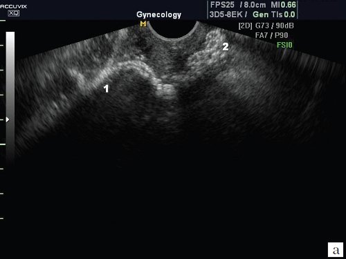 Эхограмма - деформированный prolift anterior (а): 1 - верхняя, 2 - нижняя точка положения протеза