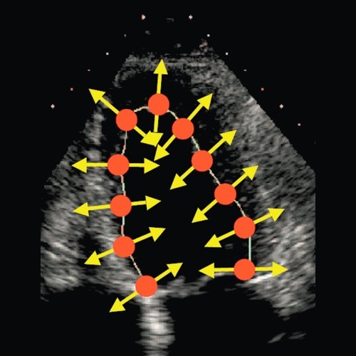 Эхограмма (В-режим) - оценка скорости движения миокарда, отслеживание перемещения естественных акустических маркеров - пятнистых структур