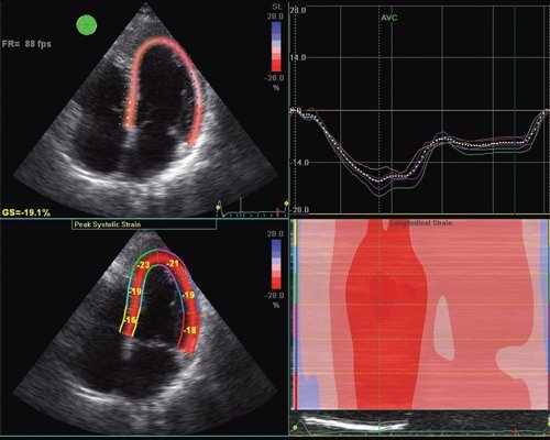 Эхограмма (В-режим) - оценка продольной деформации левого желудочка, технология speckle tracking