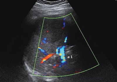 Эхограмма - кровоток в структуре образования и в паренхиме селезенки (режим ЦДК, al - селезеночная артерия)