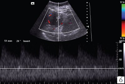 Эхограмма - гамартома селезенки (режим ЦДК и импульсной допплерографии)