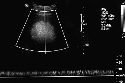 Эхограмма - регистрация венозного кровотока в структуре гамартомы