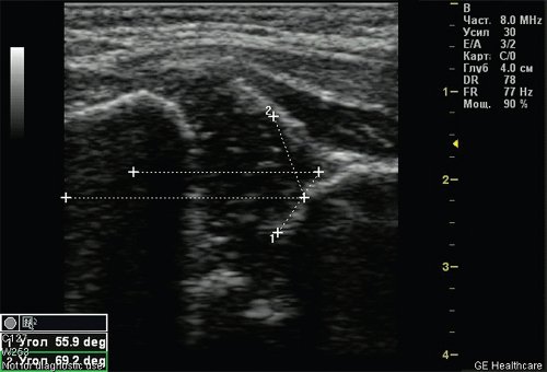 Эхограмма - тазобедренный сустав тип 2а