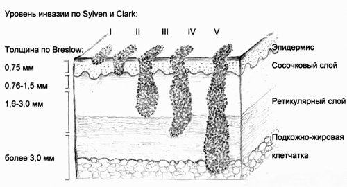 Схема - основные прогностические факторы при меланоме кожи, уровни инвазии по Силвен и Кларк, индекс Бреслоу