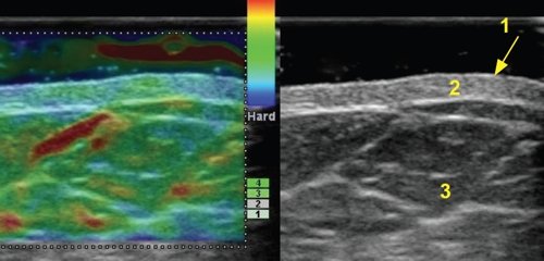 Эхограмма кожи передней грудной стенки в норме, режим компрессионной эластографии: 1 - эпидермис, 2 - дерма, 3 - подкожно-жировая клетчатка