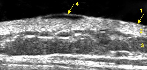 Эхограмма базалиомы кожи передней грудной стенки: 1 - эпидермис, 2 - дерма, 3 - подкожно-жировая клетчатка, 4 - базалиома