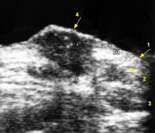 Эхограмма рака кожи спины: 1 - эпидермис, 2 - дерма, 3 - подкожно-жировая клетчатка, 4 - опухоль