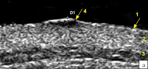Эхограмма меланомы кожи спины (B-режим): 1 - эпидермис, 2 - дерма, 3 - подкожножировая клетчатка, 4 - меланома