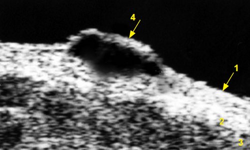 Эхограмма меланомы кожи в поясничной области: 1 - эпидермис, 2 - дерма, 3 - подкожно-жировая клетчатка, 4 - меланома