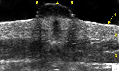 Эхограмма меланомы кожи спины (B-режим): 1 - эпидермис, 2 - дерма, 3 - подкожножировая клетчатка, 4 - меланома, 5 - боковые тени