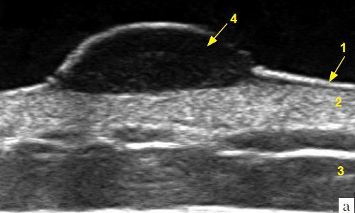 Эхограмма меланомы кожи грудной стенки (B-режим): 1 - эпидермис, 2 - дерма, 3 - подкожно-жировая клетчатка, 4 - меланома