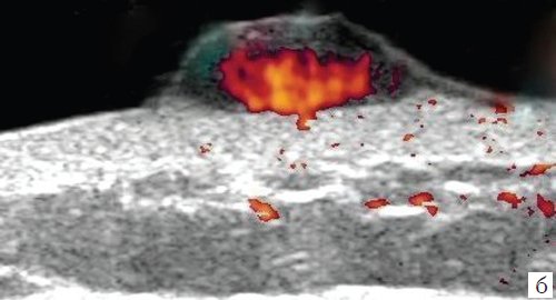 Эхограмма меланомы кожи грудной стенки, режим ЦДК