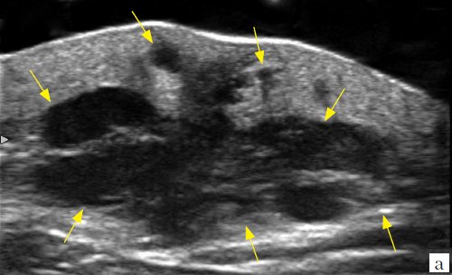 Эхограмма метастаза меланомы (стрелки) в мягкие ткани лопаточной области, B-режим