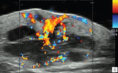 Эхограмма метастаза меланомы в мягкие ткани лопаточной области, режим ЦДК