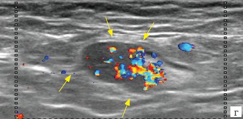 Эхограмма метастаза меланомы (стрелки) в аксиллярные лимфатические узлы, режим ЦДК