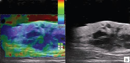 Эхограмма метастаза меланомы в мягкие ткани лопаточной области, режим компрессионной эластографии