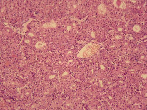 Патогистологическая картина клеток опухоли поджелудочной железы, клетки формируют железистые и трабекулярные структуры с периваскулярной ориентацией, окраска гематоксилином и эозином