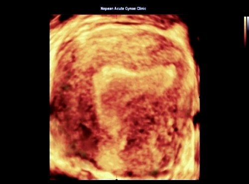 Изображение асимметричной полости матки, полученное в корональной плоскости при 3D ТВУЗИ