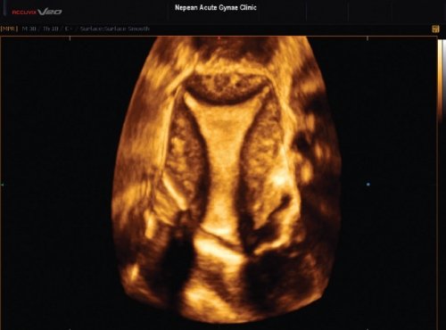 На изображении, полученном в корональной плоскости при 3D ТВУЗИ, представлена симметричная полость матки при БНЛ, которая оказалась в последующем эктопической беременностью
