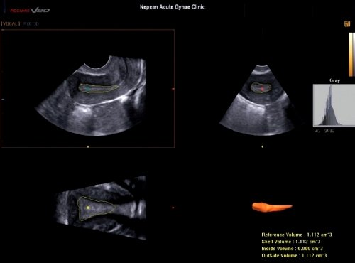 Объем эндометрия в 3D режиме, рассчитанный с применением программы VOCAL, средний индекс серой шкалы (MGSI) рассчитан при использовании свойства получения гистограммы программы VOCAL