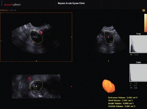 Объем яичника, индексы 3D энергетического допплера и MGSI для яичника с желтым телом, при беременности малого срока