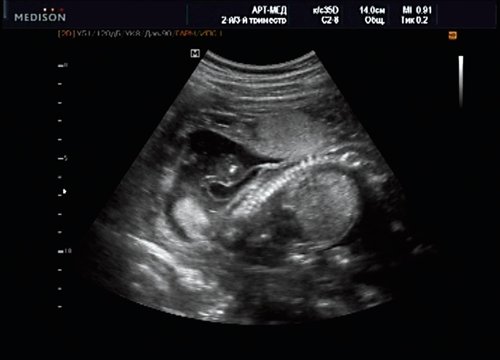 Эхограмма - менингоцеле, типичное кистозное образование стебельчатой формы, беременность 20 недель 