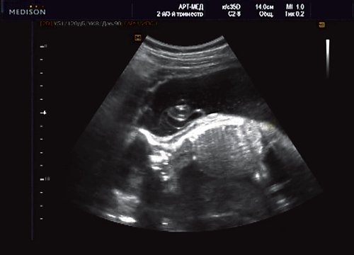 Эхограмма - менингоцеле, беременность 20 недель