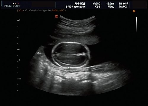 Эхограмма - гидроцефалия, беременность 20 недель 