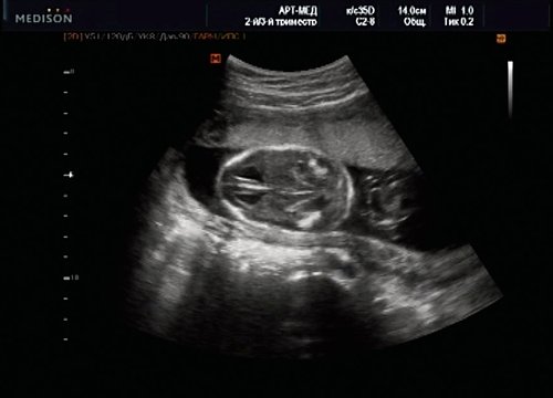 Эхограмма - удлинение ножек мозга и вклинение мозжечка в затылочное отверстие при синдроме Арнольда - Киари II, беременность 20 недель