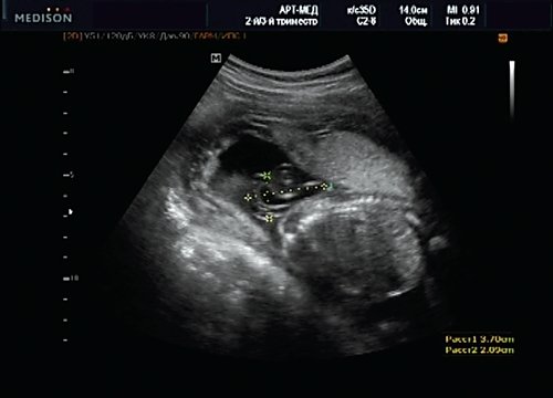 Эхограмма - менингоцеле размером 37х21 мм, беременность 20 недель 