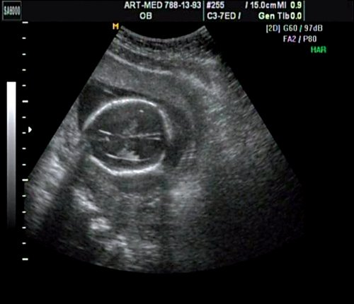 Эхограмма - гидроцефалия, беременность 18 недель