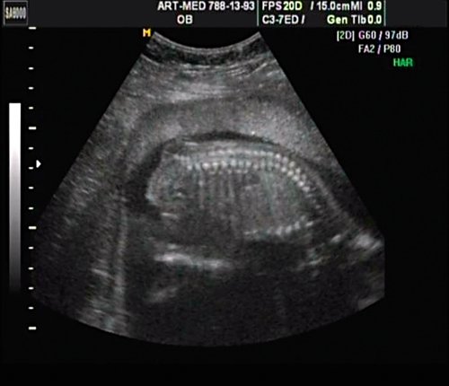Эхограмма - spina bifida в крестцовом отделе, беременность 18 недель 