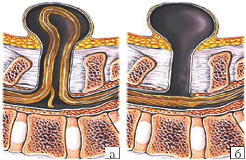 Схема дефектов позвоночника плода: а - meningomyelocele, б - meningocele