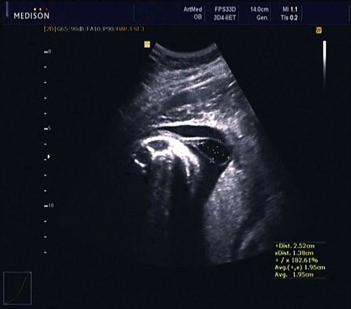 Эхограмма - стебельчатая форма менингоцеле, беременность 30 недель 