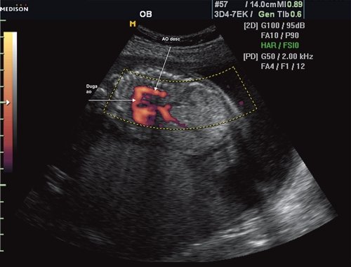 Эхограмма - восходящий отдел, дуга и нисходящий отдел аорты плода (режим энергетического допплера, норма)
