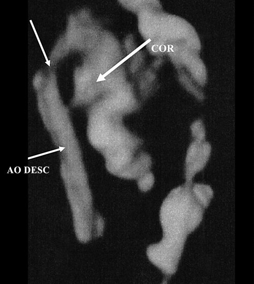 Эхограмма сердца и аорты плода (режим 3D), беременность 16 недель, cтрелкой указано место сужения аорты (AO DESC - нисходящий отдел аорты, COR - сердце)