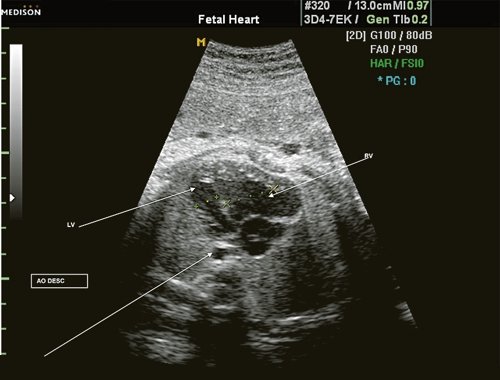 Эхограмма - диспропорция размеров желудочков сердца при коарктации аорты (RV - правый желудочек; LV - левый желудочек; AO DESC - поперечное сечение нисходящего отдела аорты)