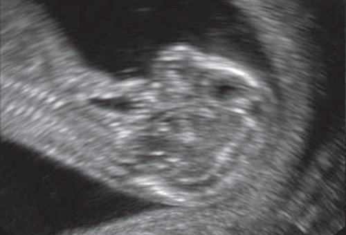 Эхограмма - профиль плода, синдром агнатии-голопрозэнцефалии, беременность 12 недель