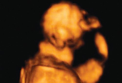 Фенотип лица плода при синдроме агнатииголопрозэнцефалии, беременность 12 недель