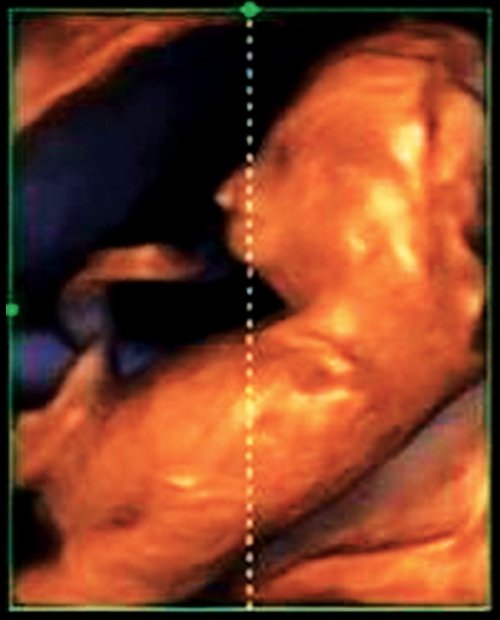 Эхограмма - микрогнатия у плода, синдром Пьера Робена, беременность 13 недель