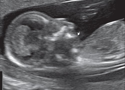 Эхограмма - микрогнатия у плода с ахондрогенезом, беременность 13 недель