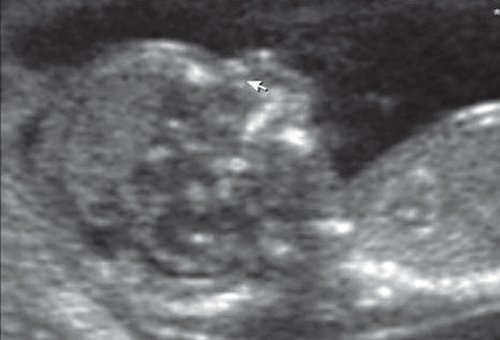 Эхограмма - микрогнатия у плода, синром диастрофической дисплазии, беременность 12 недель