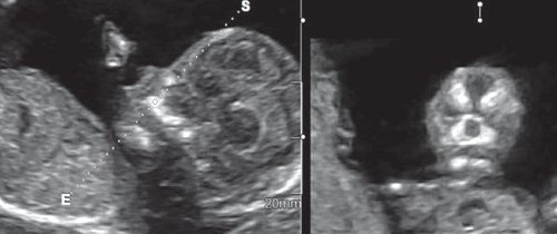 Эхограмма - методика оценки коронарного скана лица плода в I триместре беременности